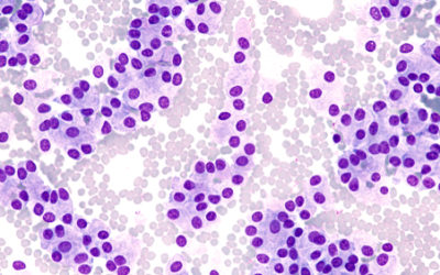 Estimating undiagnosed cancers on the RTT waiting list